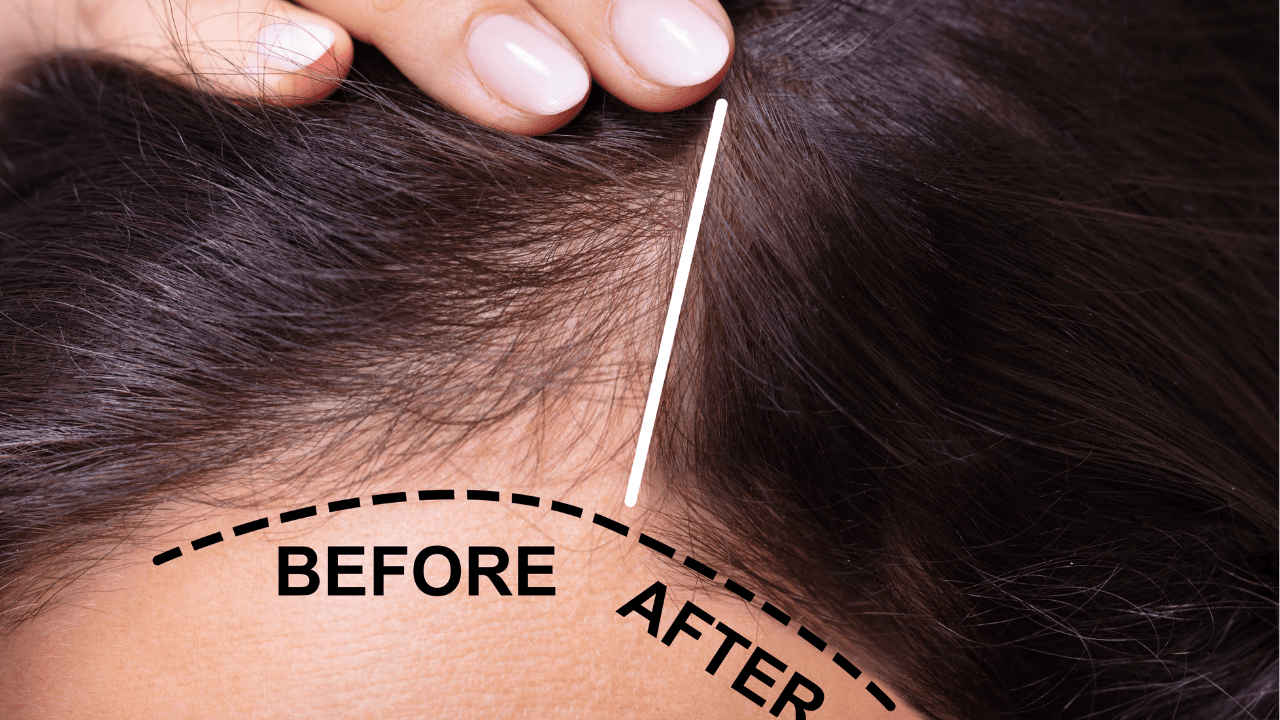 Hair Loss Treatment in Korea: Diagnosis, Medical Options, PRP, and Travel Planning