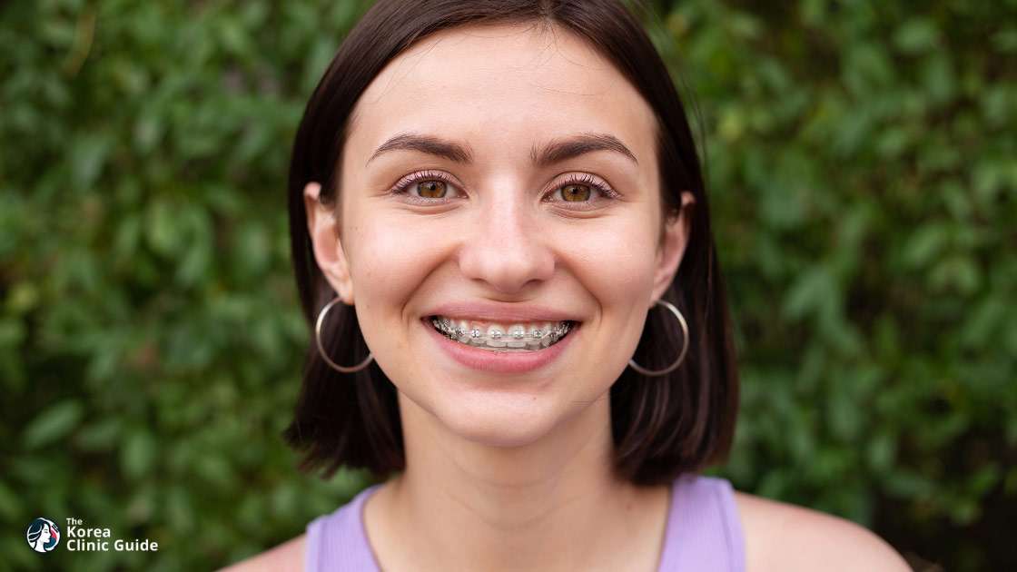 Braces in Korea | Best Clinics, Costs, Procedure Types & More