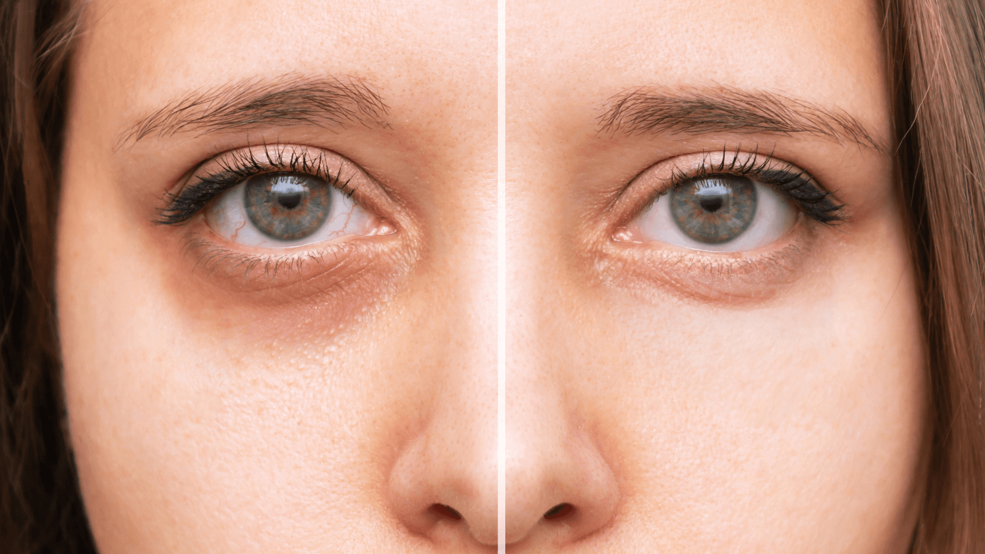 Facial Filler in Korea | Best Clinics, Costs, Procedure Types & More