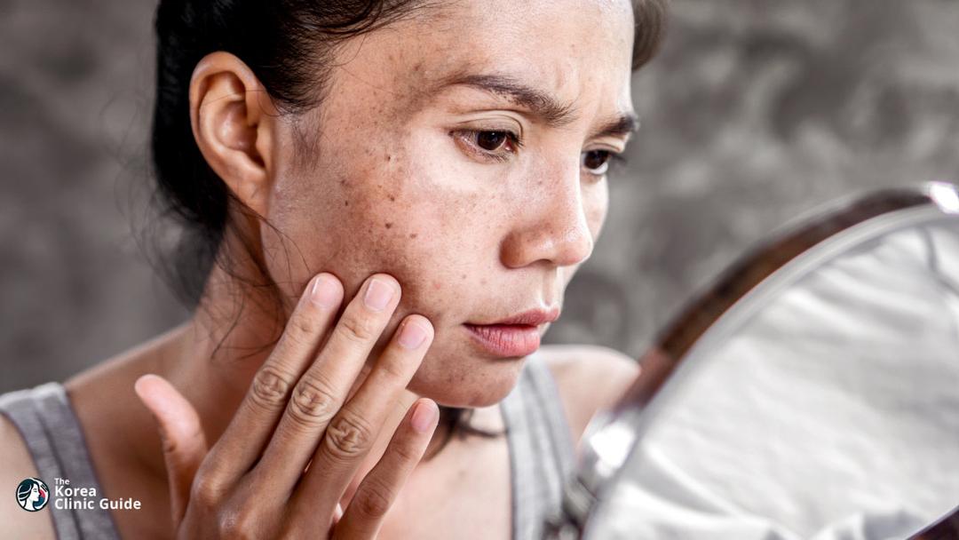 pigmentation treatment