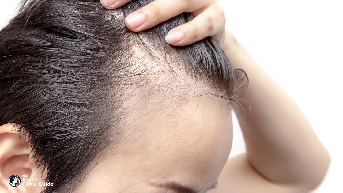 Hairline Correction in Korea: Methods, Recovery, Travel Planning, and Risks