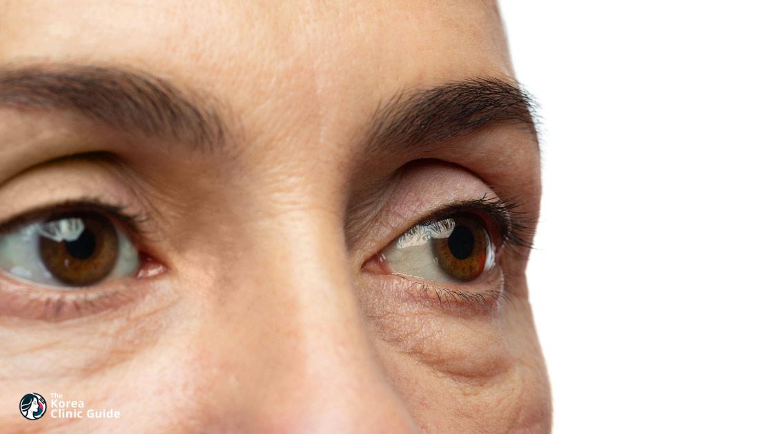 Blepharoplasty in Korea: Types, Recovery, Travel Planning, and Safety
