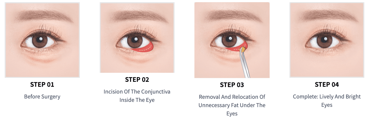 Under Eye Fat Removal or Repositioning, Under Eye Fat Grafting