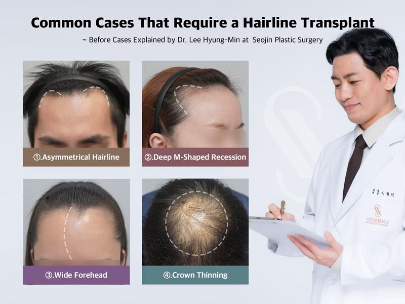 Hair Transplant, Hairline Correction