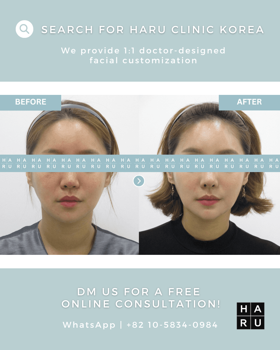 Chin Filler, Chin Botox, Fat Dissolving Injection