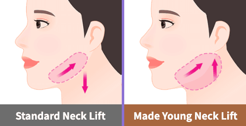 Neck Lift