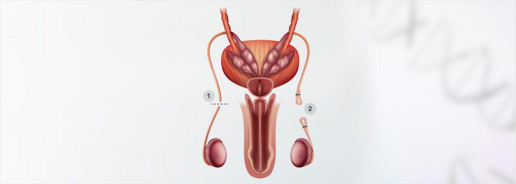 Vasectomy