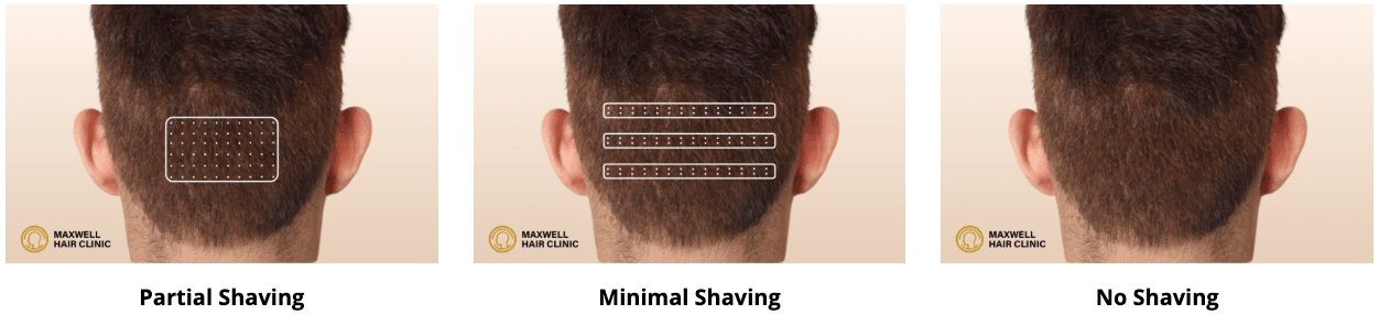 Hair transplant on Scar, Hair Transplant, Hairline Correction