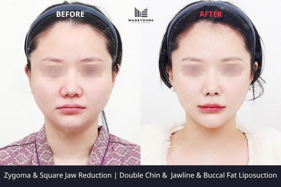 Reduction square jaw reduction double chin liposuction jawline liposuction buccal fat removal 1