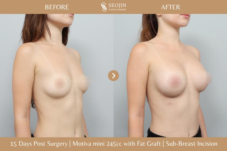 Seojin Plastic Surgery Clinic before and after image
