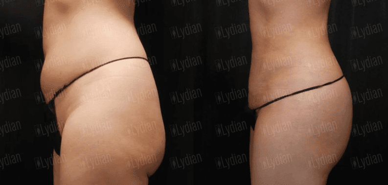 mini liposuction before after