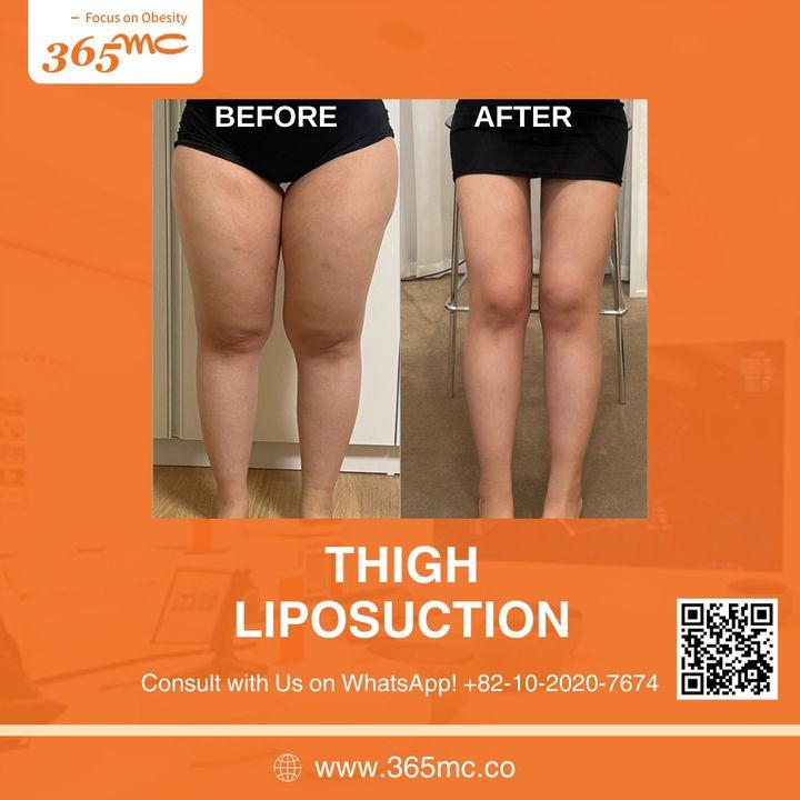 Slimmer, smoother thighs are within reach. Explore our before and after photos to see the sculpting power of our thigh liposuction procedures.