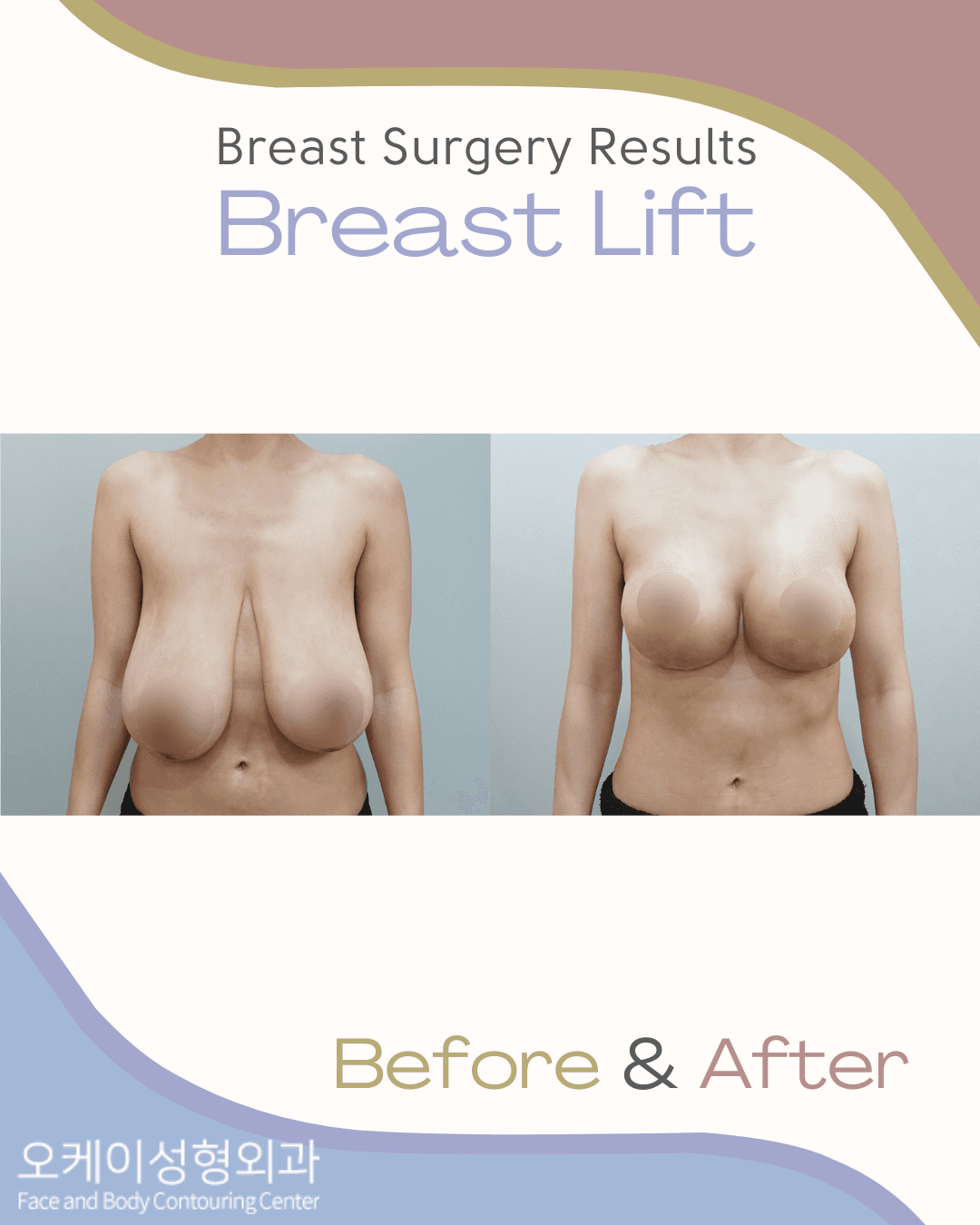 Okay Plastic Surgery Clinic before and after image