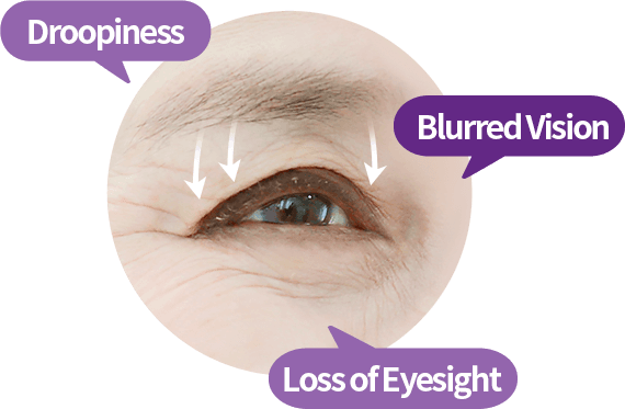 Blepharoplasty
