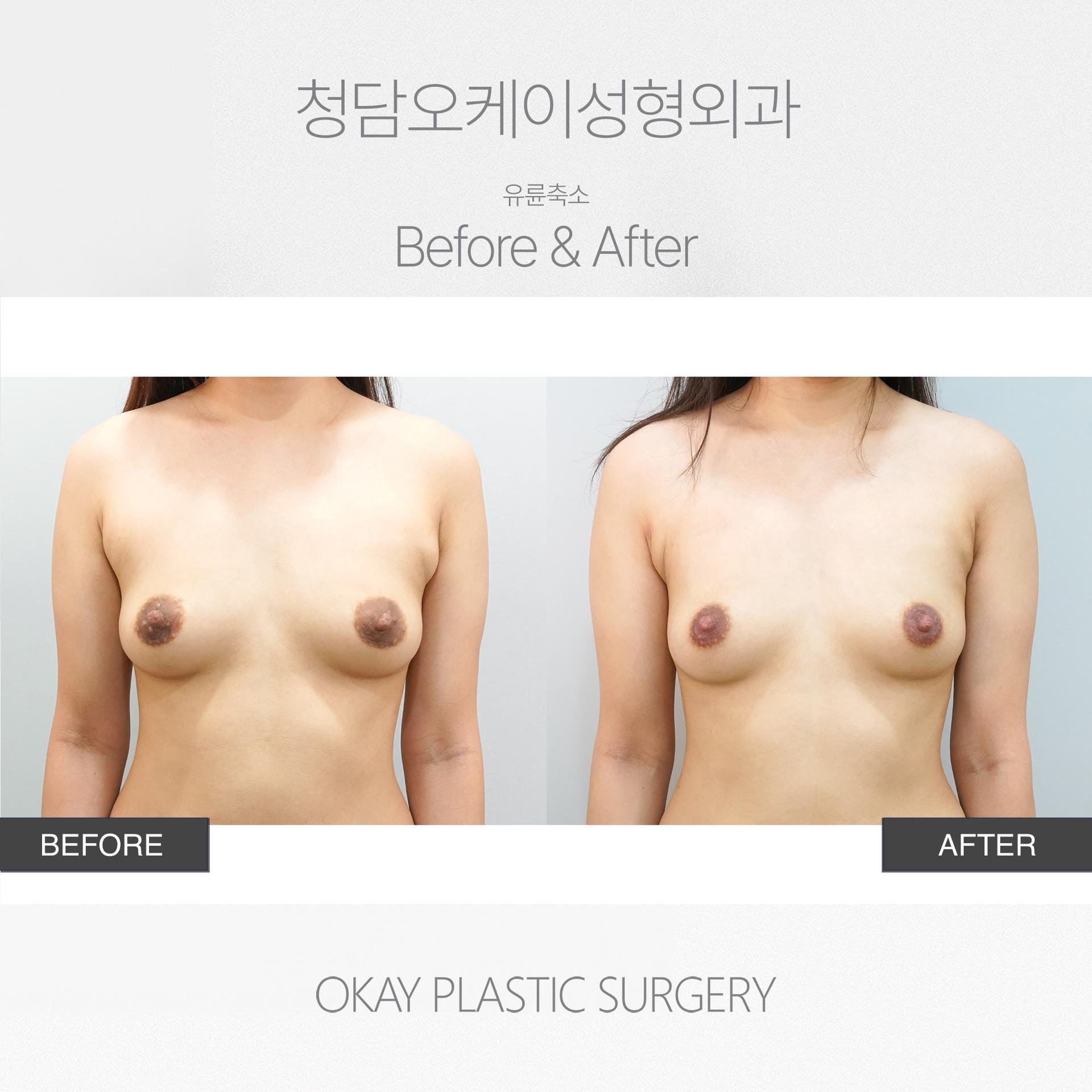 Okay Plastic Surgery Clinic before and after image