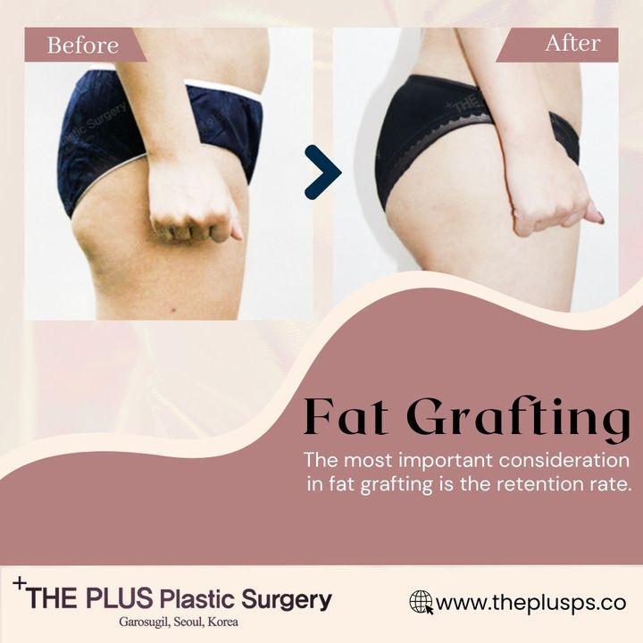 Understanding Fat Grafting for Butt Enhancement at ThePlus! 🍑✨ Discover the transformative approach of using your body's own fat to sculpt and shape a fuller, natural buttock. Unlike implants, fat grafting offers a more organic result, blending seamlessly with your body. Curious about the process? Let's delve into the science of enhancing your curves naturally! ►