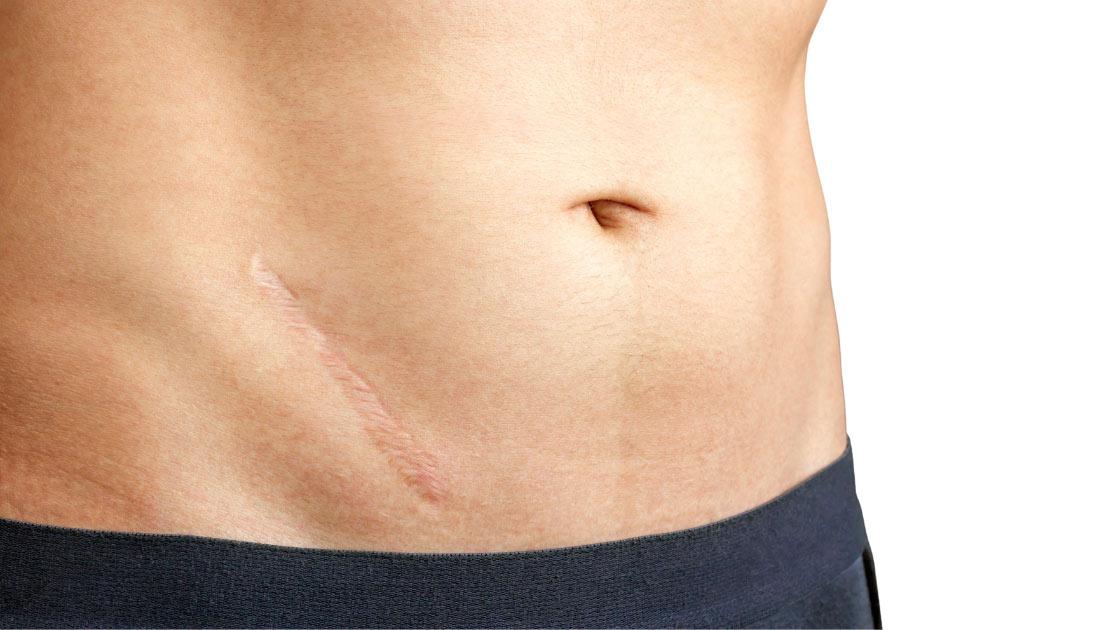 Scar Removal Surgery, Scar Removal Laser, Steroid Injections for Scars