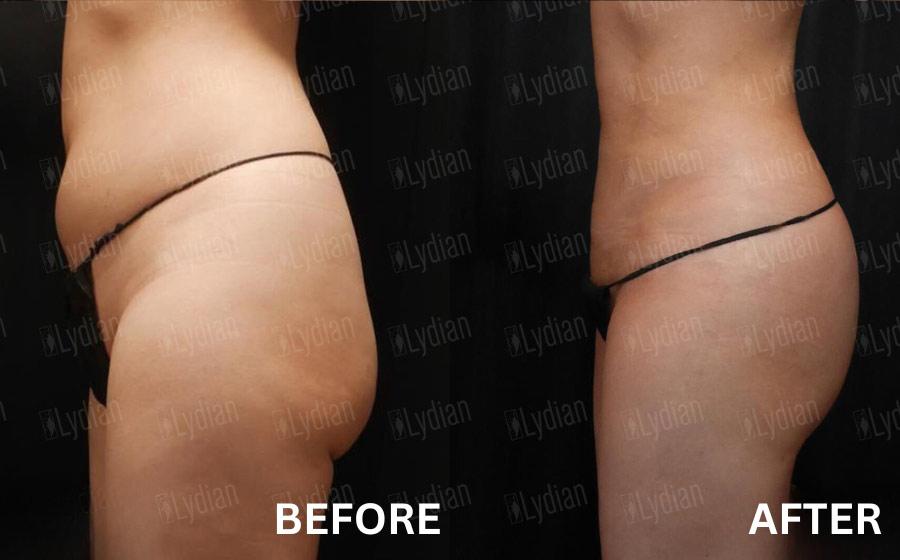 Before and After Brazilian Butt Lift