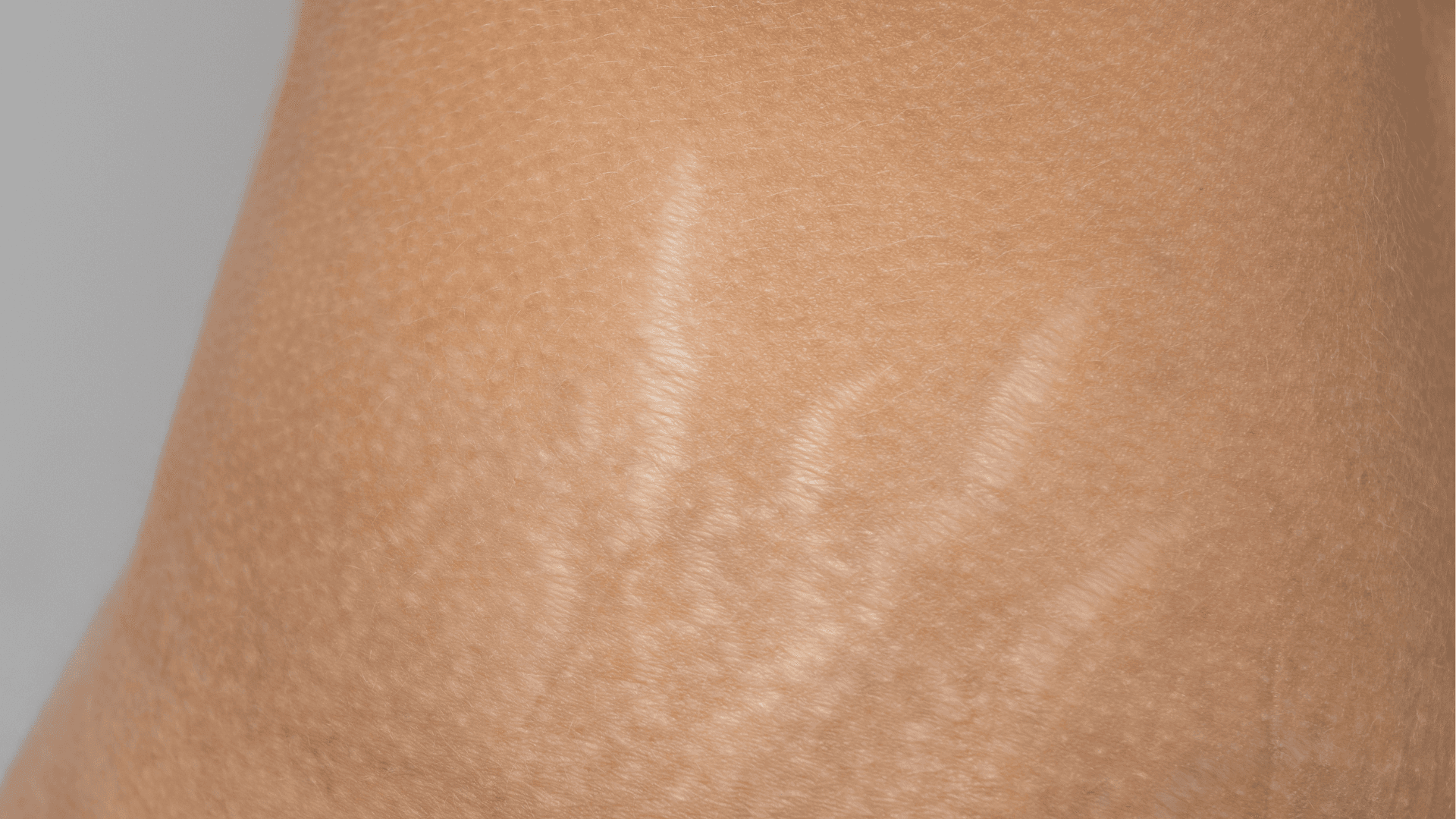 Stretch Mark Treatment