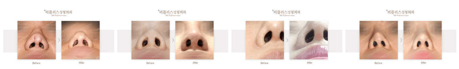 Revision Rhinoplasty