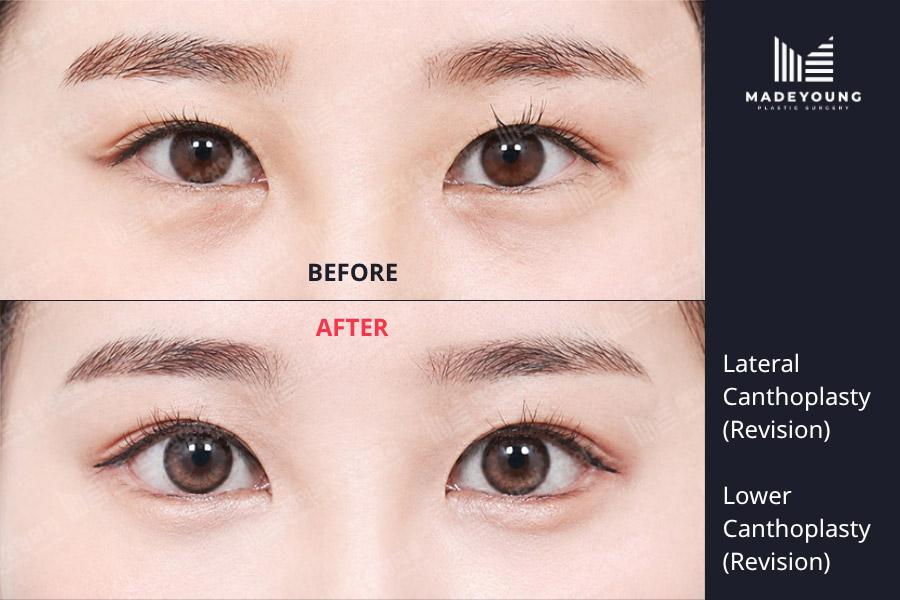 Canthoplasty revision lower canthoplasty revision