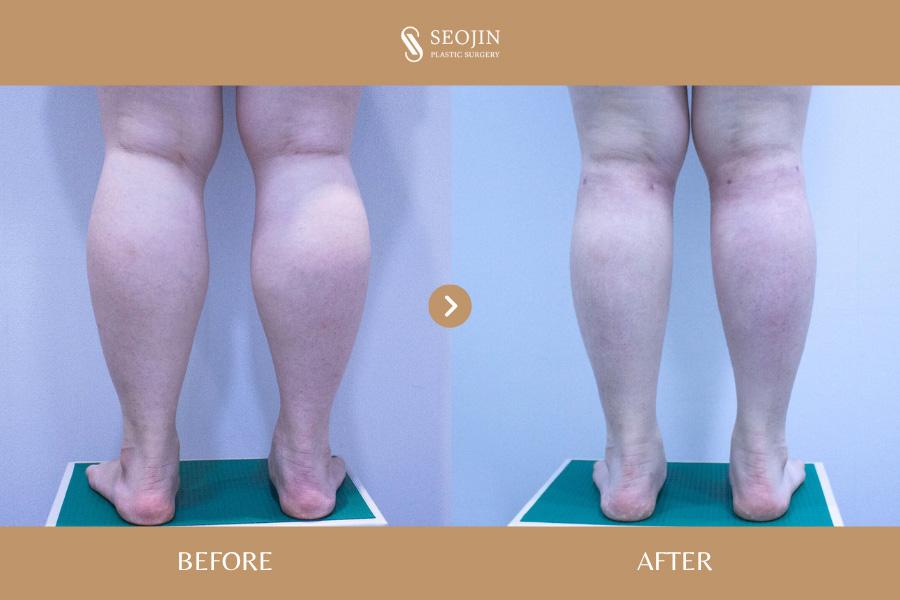 Seojin Plastic Surgery Clinic before and after image