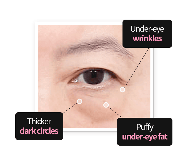 Blepharoplasty