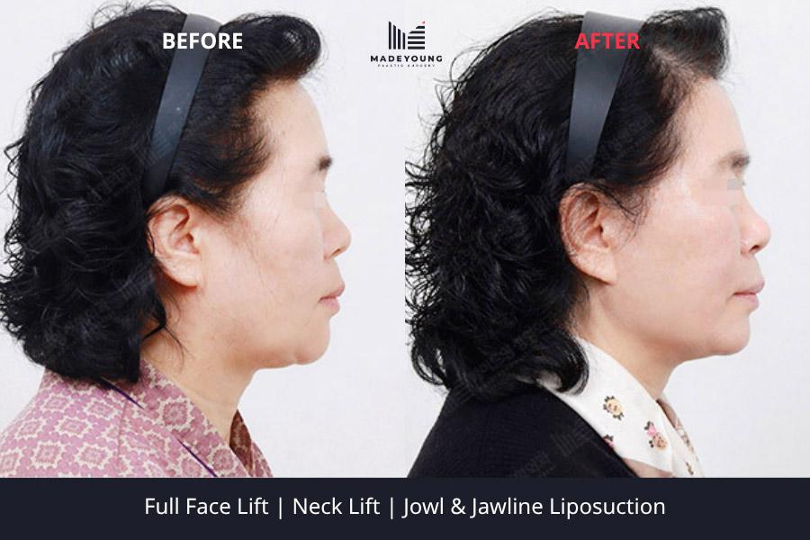 Face lift neck lift jowl jawline liposuction