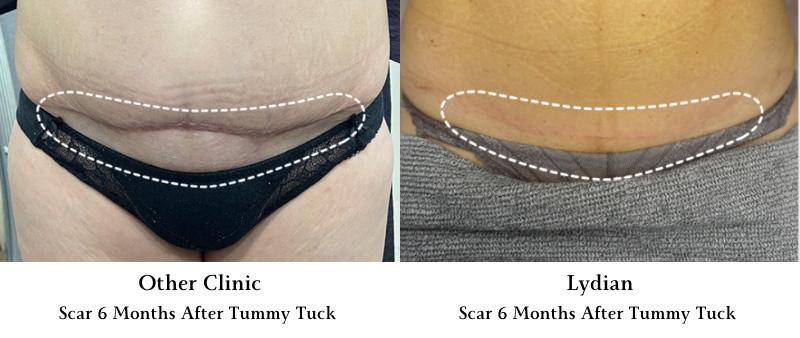 Tummy Tuck, Mommy Makeover