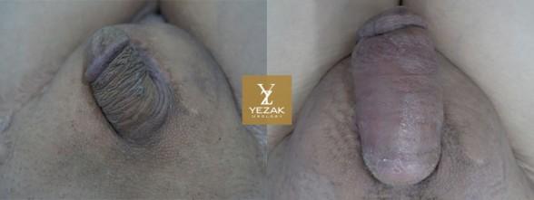 Comprehensive Penile Enhancement at Yezak Penis Enlargement + Penis Lengthening + Glans Enlargement + Premature Ejaculation Treatment + Erectile Dysfunction Treatment