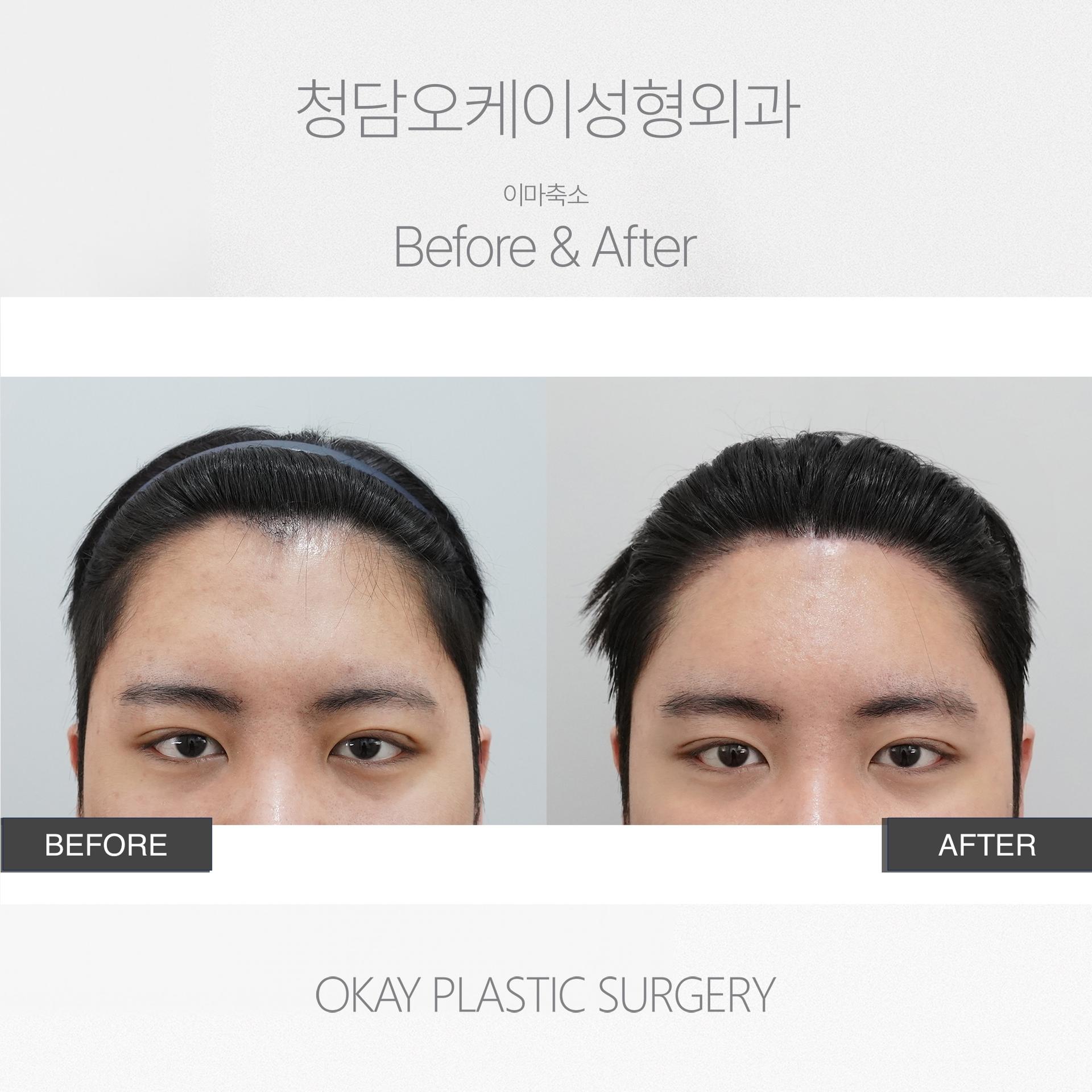 Okay Plastic Surgery Clinic before and after image