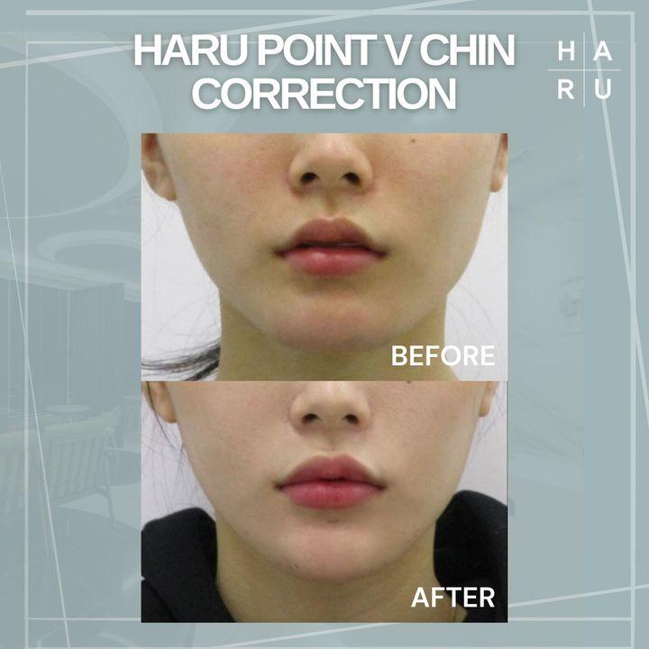 Transform your jawline with our Point V Chin Correction, a non-surgical procedure offering results comparable to bone reduction surgery. đ