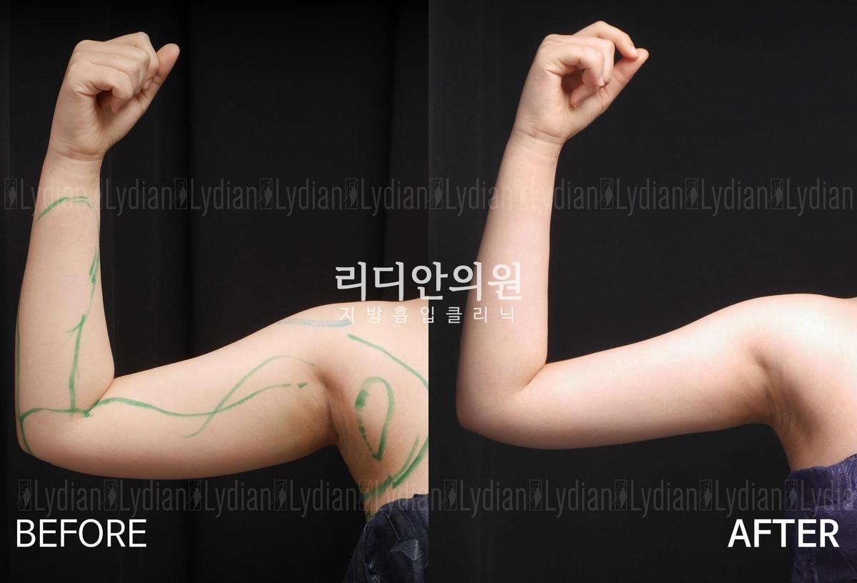 Before and After Arm Liposuction