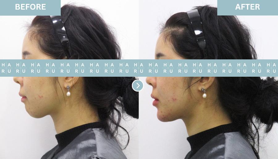 Point V Chin Correction