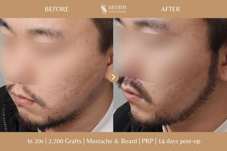 Seojin Plastic Surgery Clinic before and after image