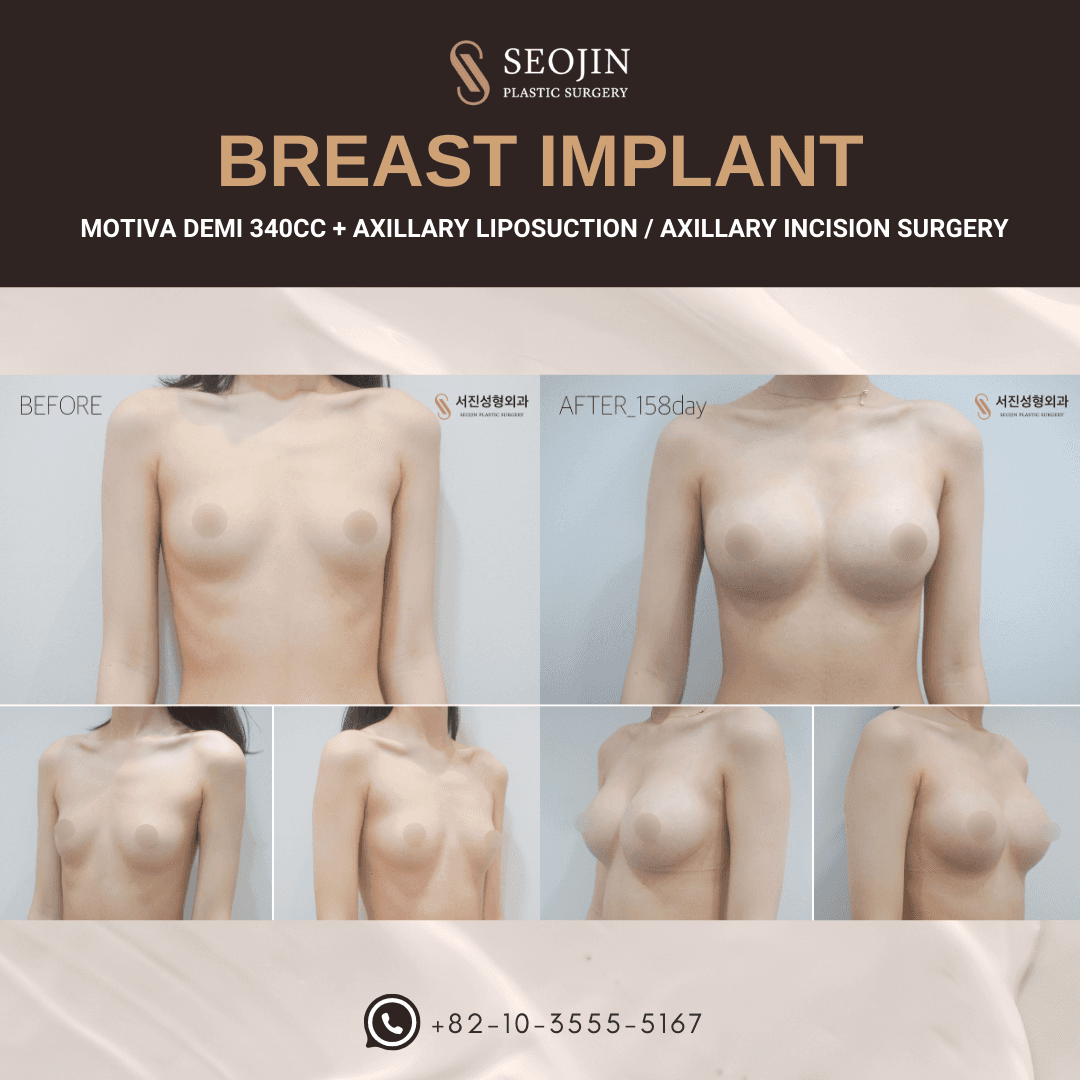 Breast Implant