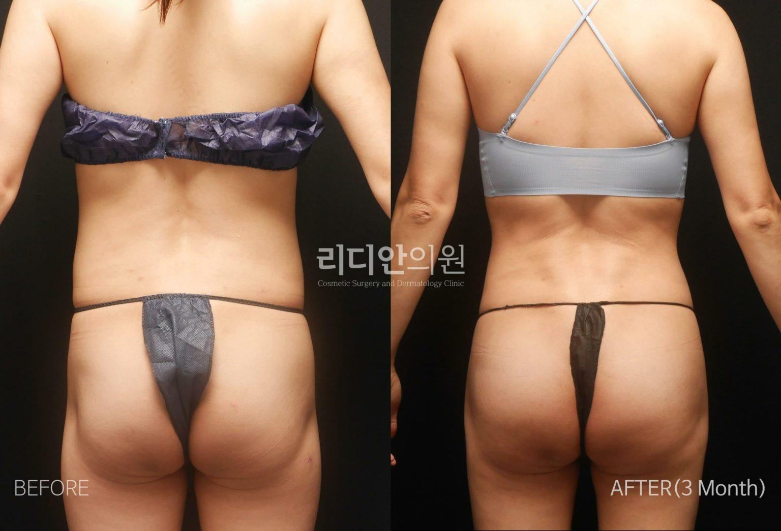 Lydian Plastic Surgery Clinic before and after image