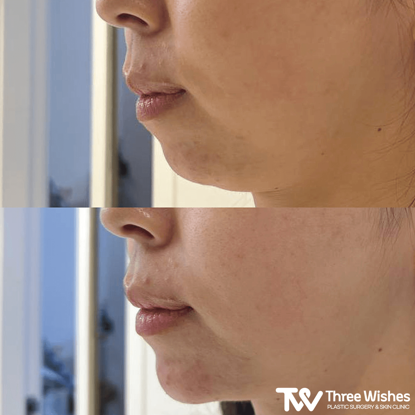 Three Wishes Clinic - Myeongdong before and after image