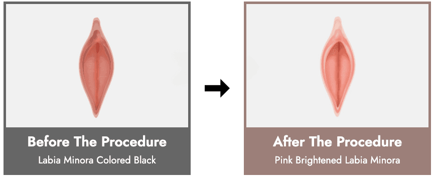Vaginal Bleaching, Labia Majora Whitening, Labia Minora Whitening