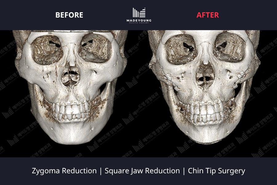 Reduction square jaw reduction chin tip surgery 1