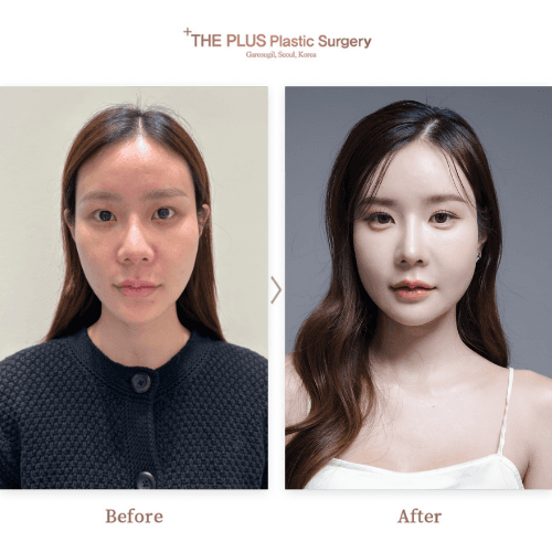 Zygoma Reduction & Square Jaw Reduction & Fat Grafting & Non-incisional Double Eyelid Surgery & Breast Augmentation