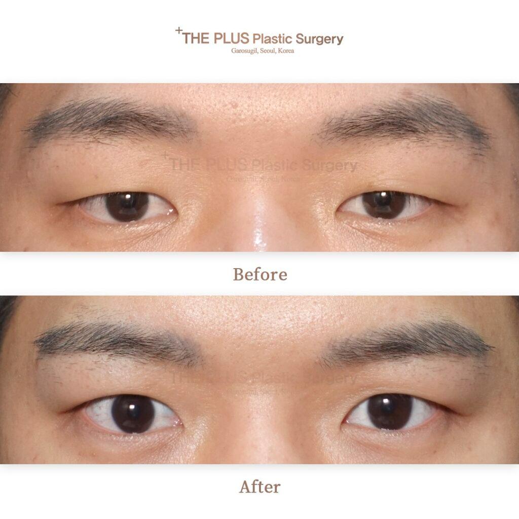 Ptosis Correction