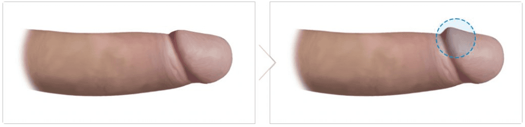 Glans Enlargement
