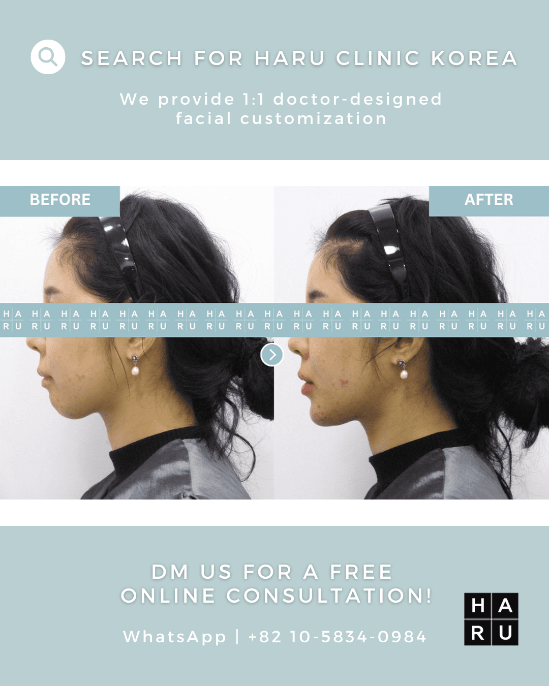 Chin Filler, Chin Botox, Fat Dissolving Injection