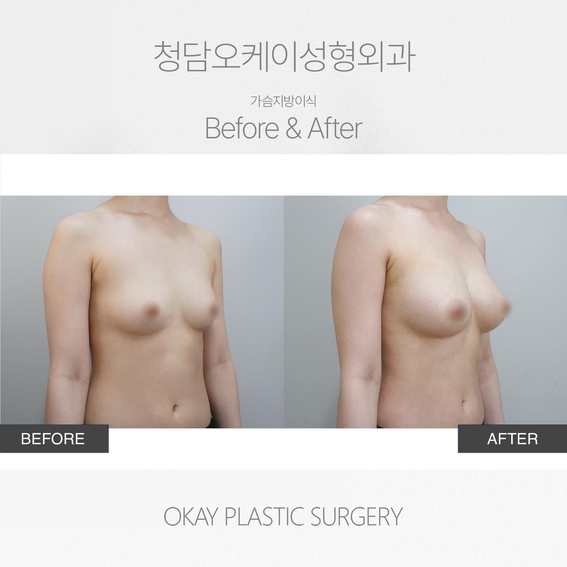 Okay Plastic Surgery Clinic before and after image