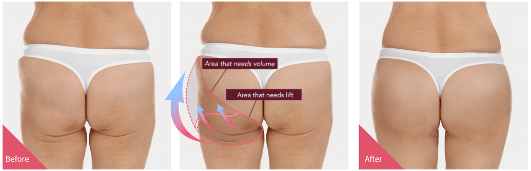 Brazilian Butt Lift, Body Fillers