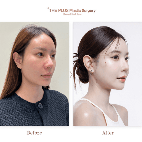 Zygoma Reduction & Square Jaw Reduction & Fat Grafting & Non-incisional Double Eyelid Surgery & Breast Augmentation