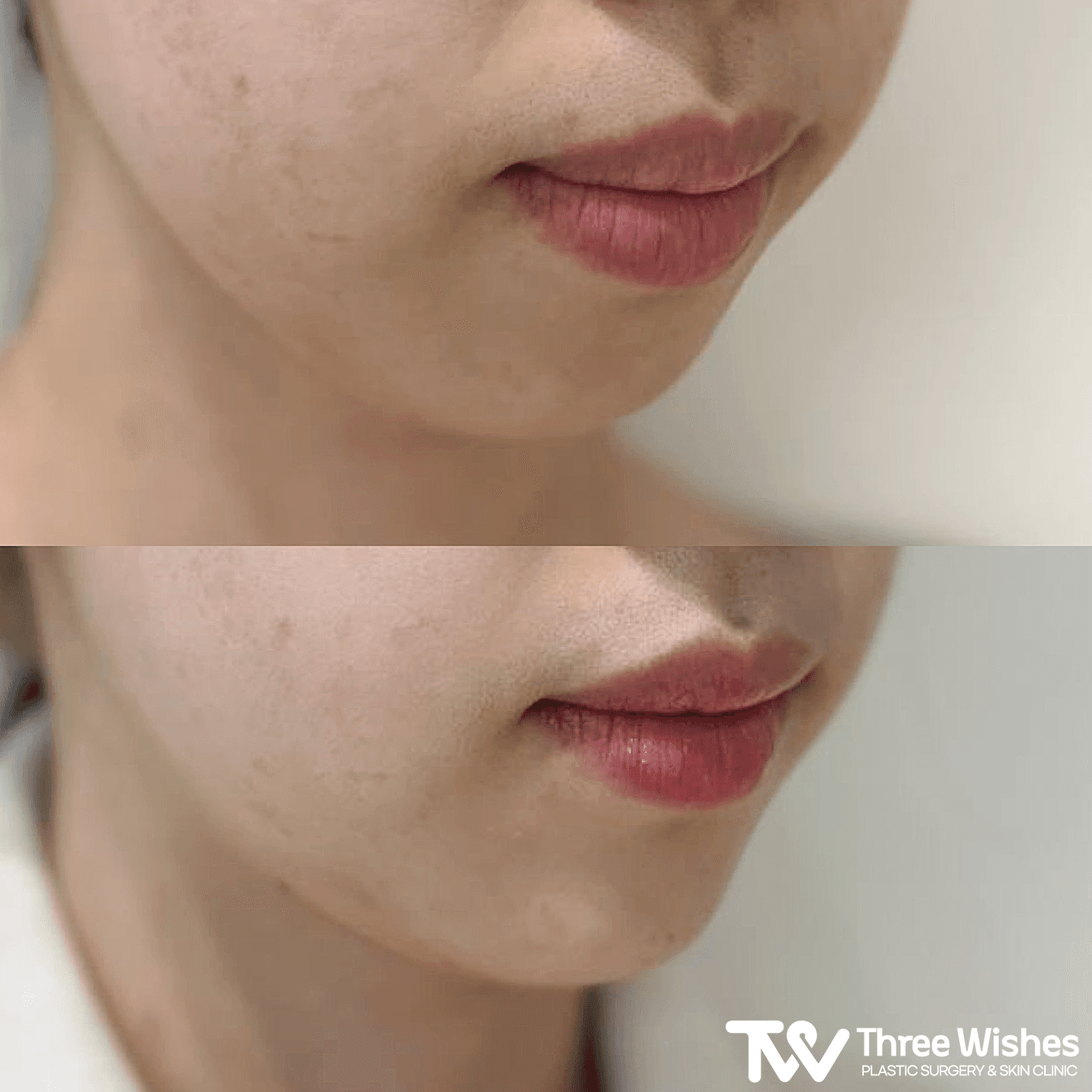 Three Wishes Clinic - Myeongdong before and after image