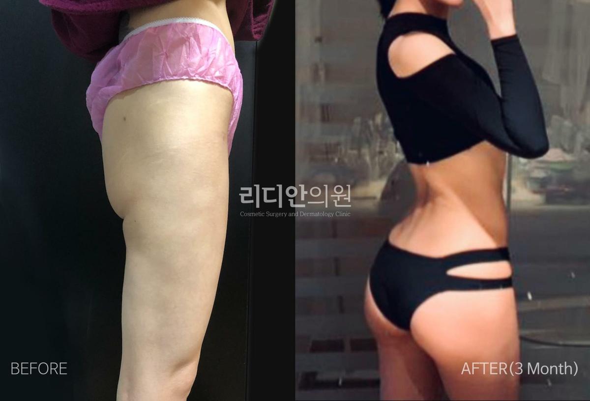 Before and After Brazilian Butt Lift