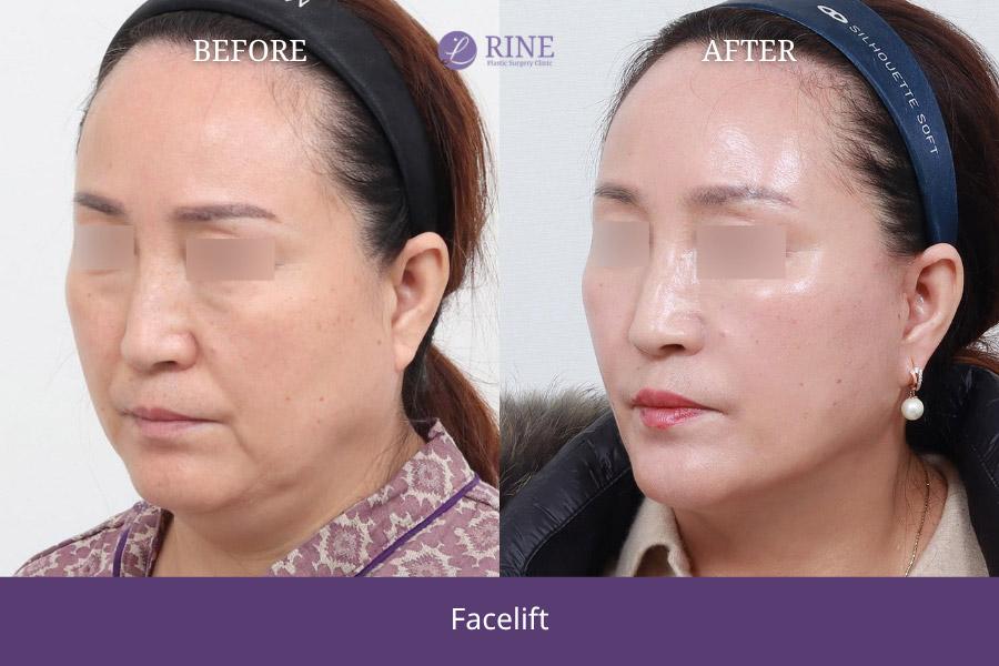 SMAS Facelift